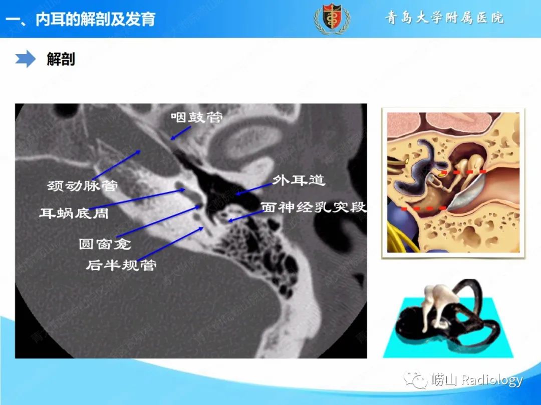 影像PPT - 【PPT】内耳畸形的影像学诊断-13