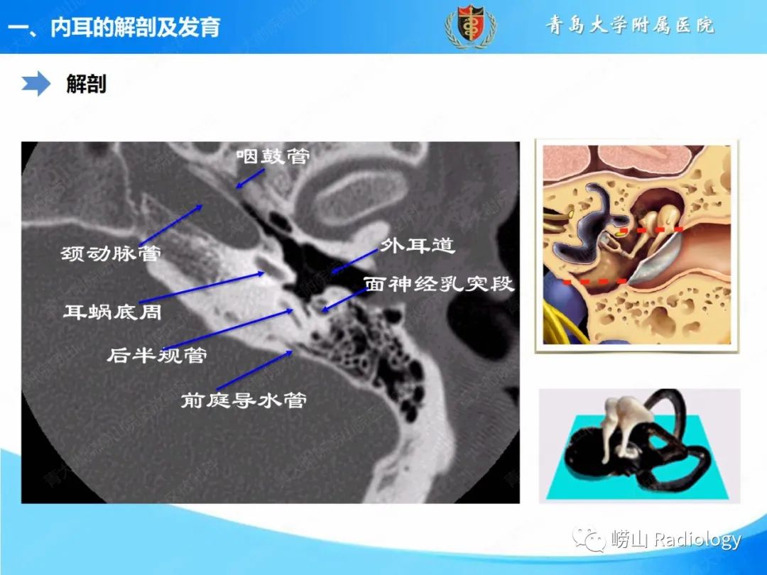影像PPT - 【PPT】内耳畸形的影像学诊断-14