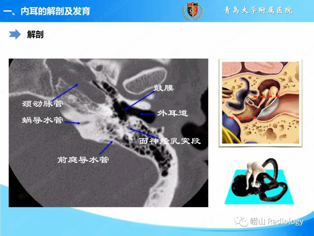 影像PPT - 【PPT】内耳畸形的影像学诊断-15