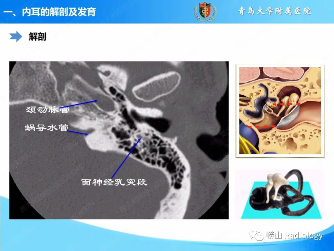 影像PPT - 【PPT】内耳畸形的影像学诊断-16
