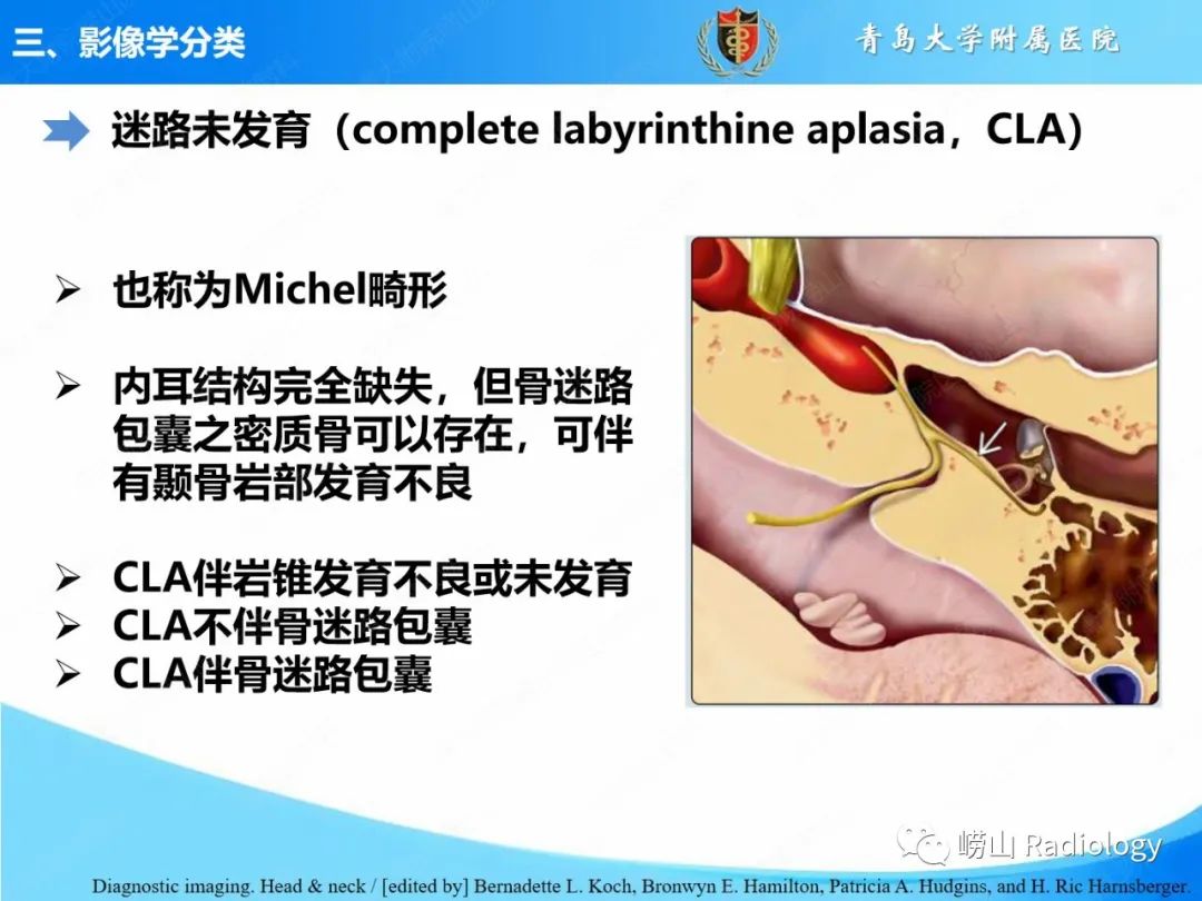 影像PPT - 【PPT】内耳畸形的影像学诊断-21