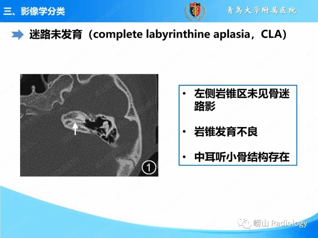 影像PPT - 【PPT】内耳畸形的影像学诊断-22