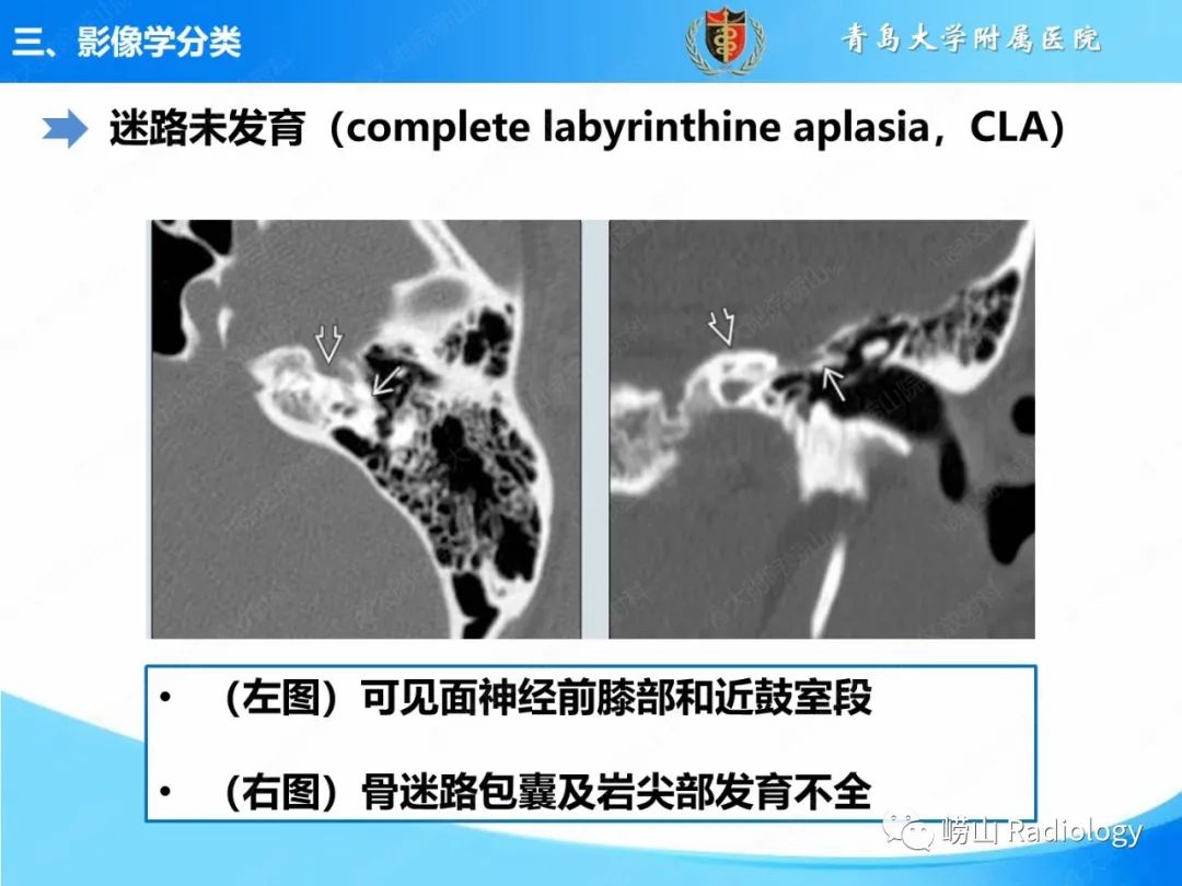影像PPT - 【PPT】内耳畸形的影像学诊断-23