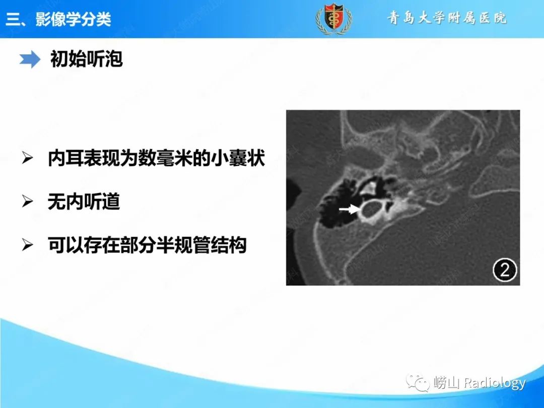 影像PPT - 【PPT】内耳畸形的影像学诊断-24