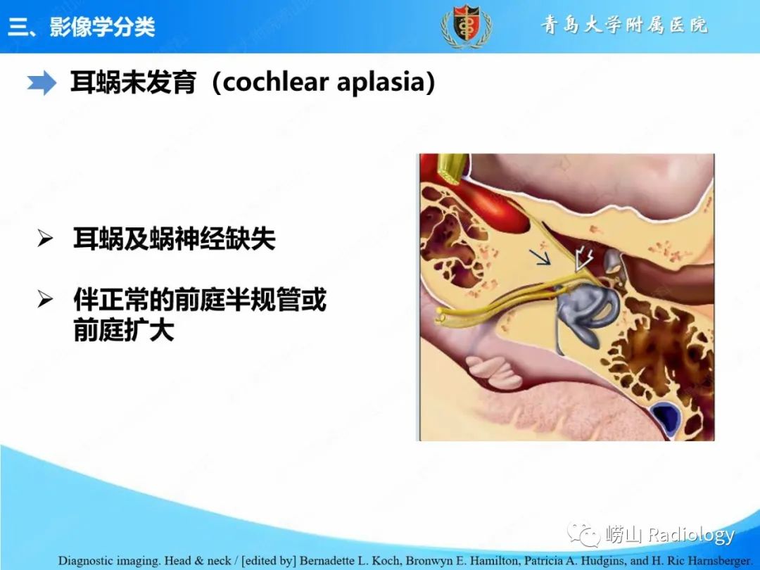 影像PPT - 【PPT】内耳畸形的影像学诊断-25