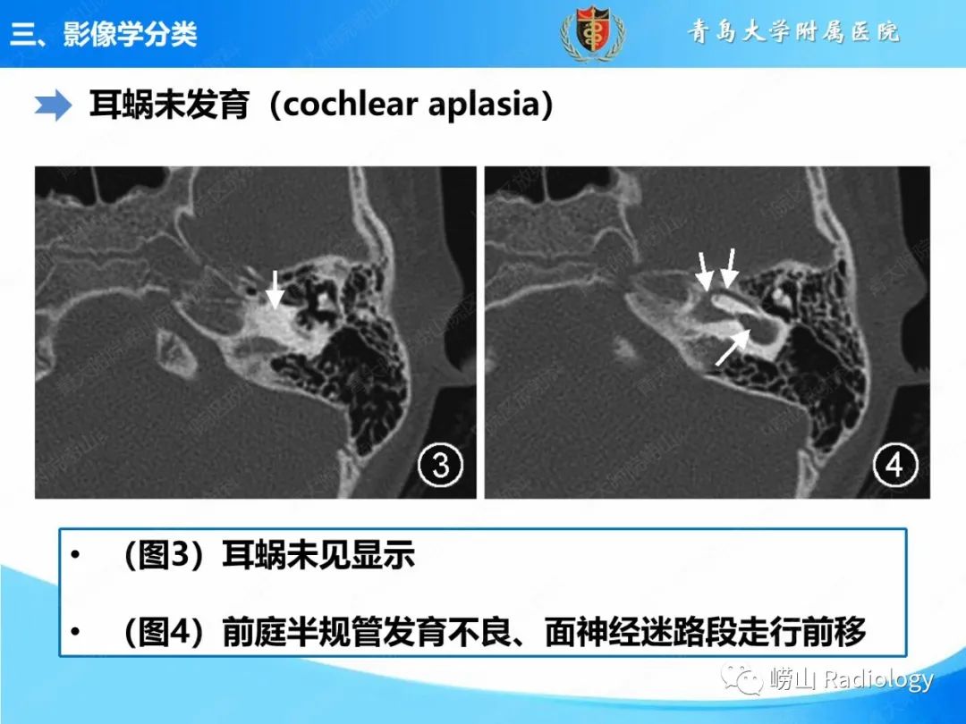 影像PPT - 【PPT】内耳畸形的影像学诊断-26