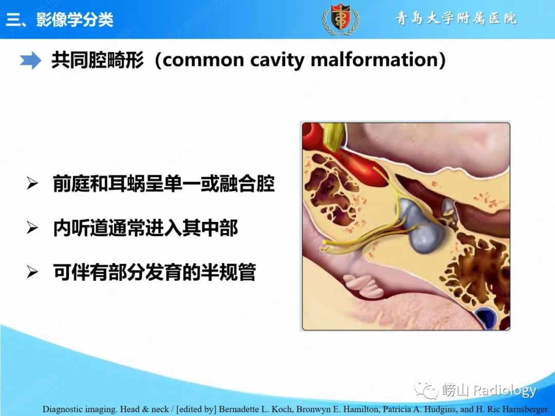影像PPT - 【PPT】内耳畸形的影像学诊断-27