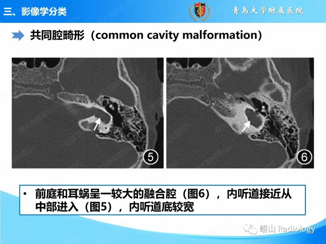影像PPT - 【PPT】内耳畸形的影像学诊断-28