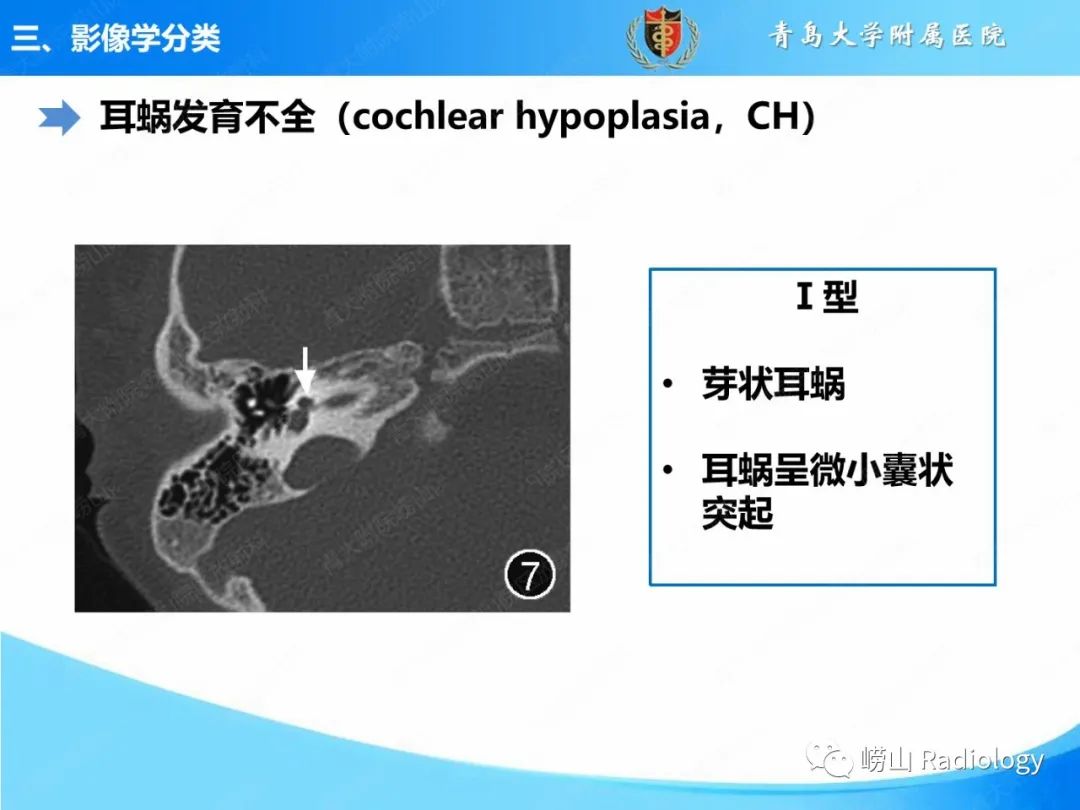 影像PPT - 【PPT】内耳畸形的影像学诊断-30