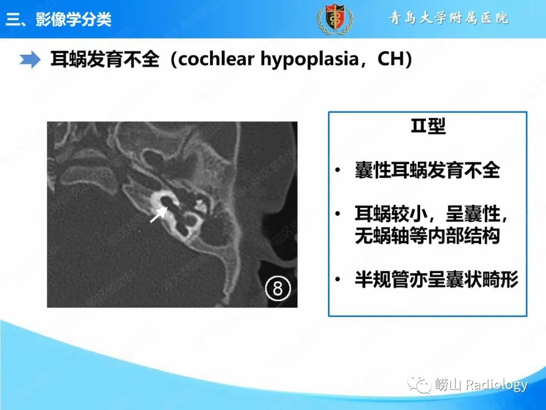 影像PPT - 【PPT】内耳畸形的影像学诊断-31
