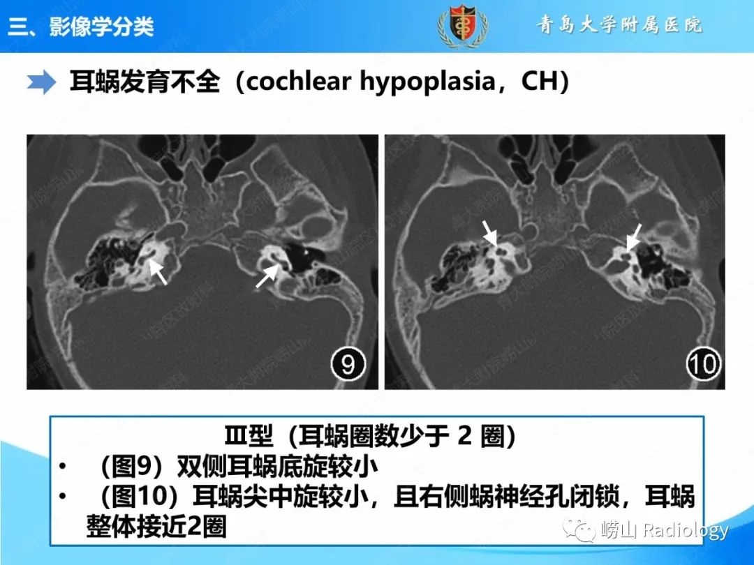 影像PPT - 【PPT】内耳畸形的影像学诊断-32