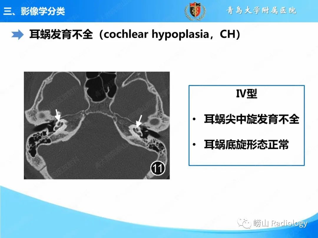 影像PPT - 【PPT】内耳畸形的影像学诊断-33