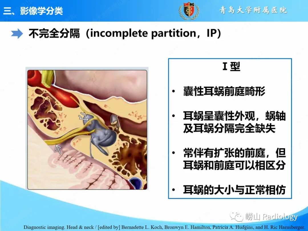 影像PPT - 【PPT】内耳畸形的影像学诊断-34