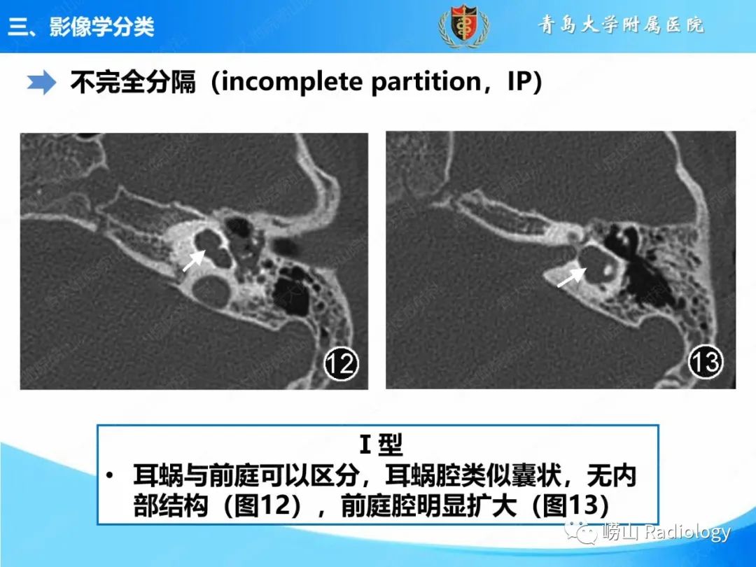 影像PPT - 【PPT】内耳畸形的影像学诊断-35