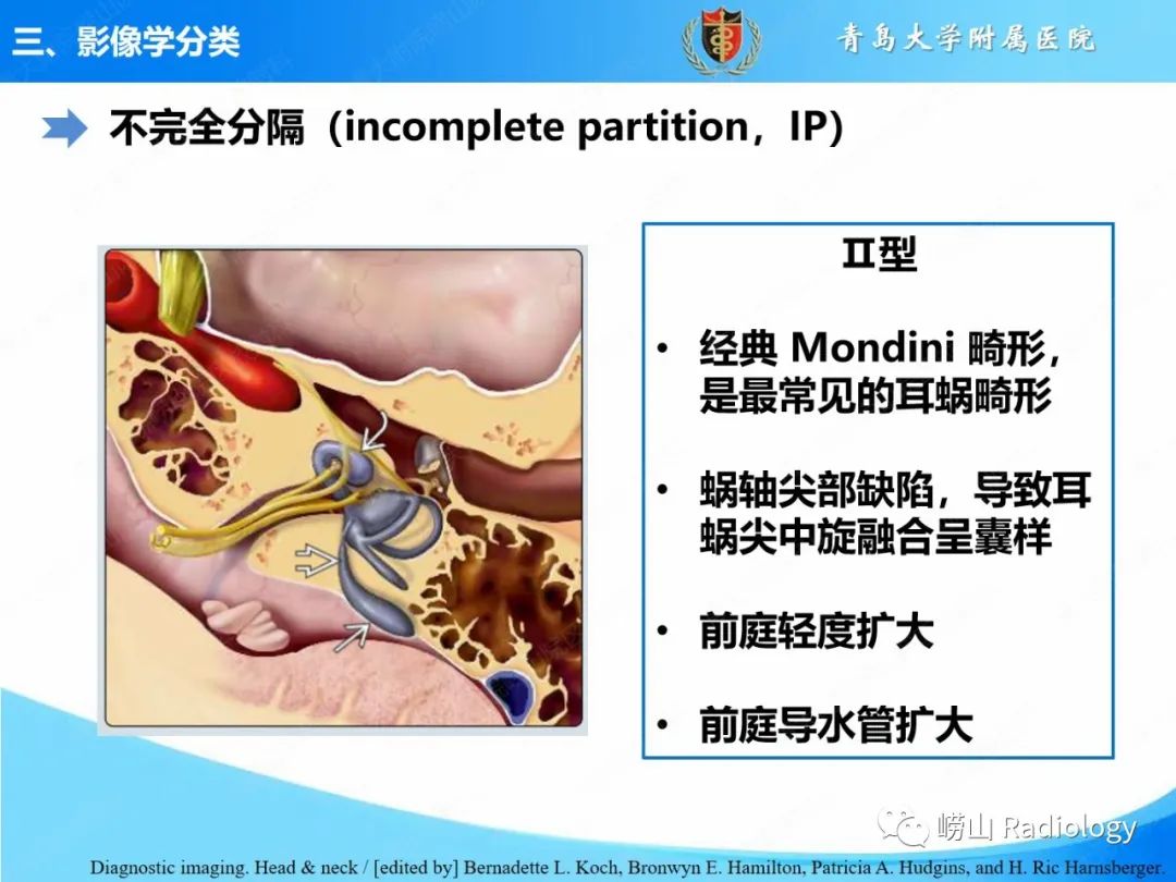影像PPT - 【PPT】内耳畸形的影像学诊断-36