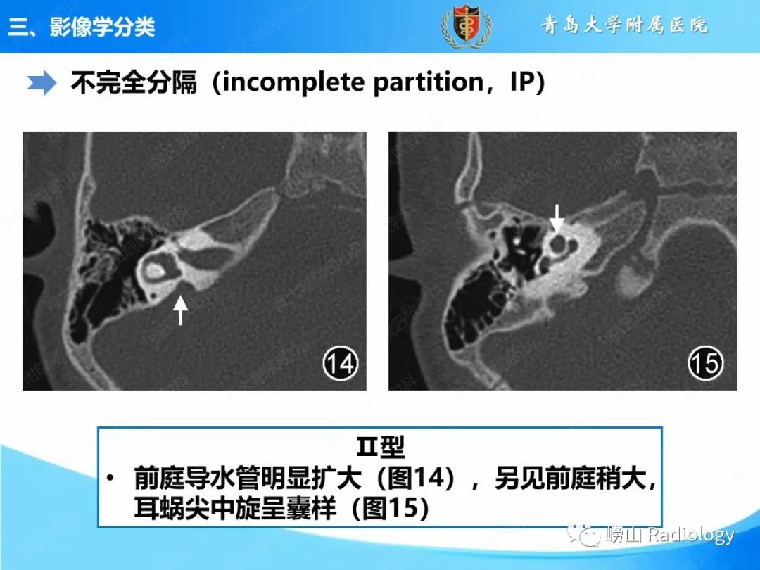 影像PPT - 【PPT】内耳畸形的影像学诊断-37