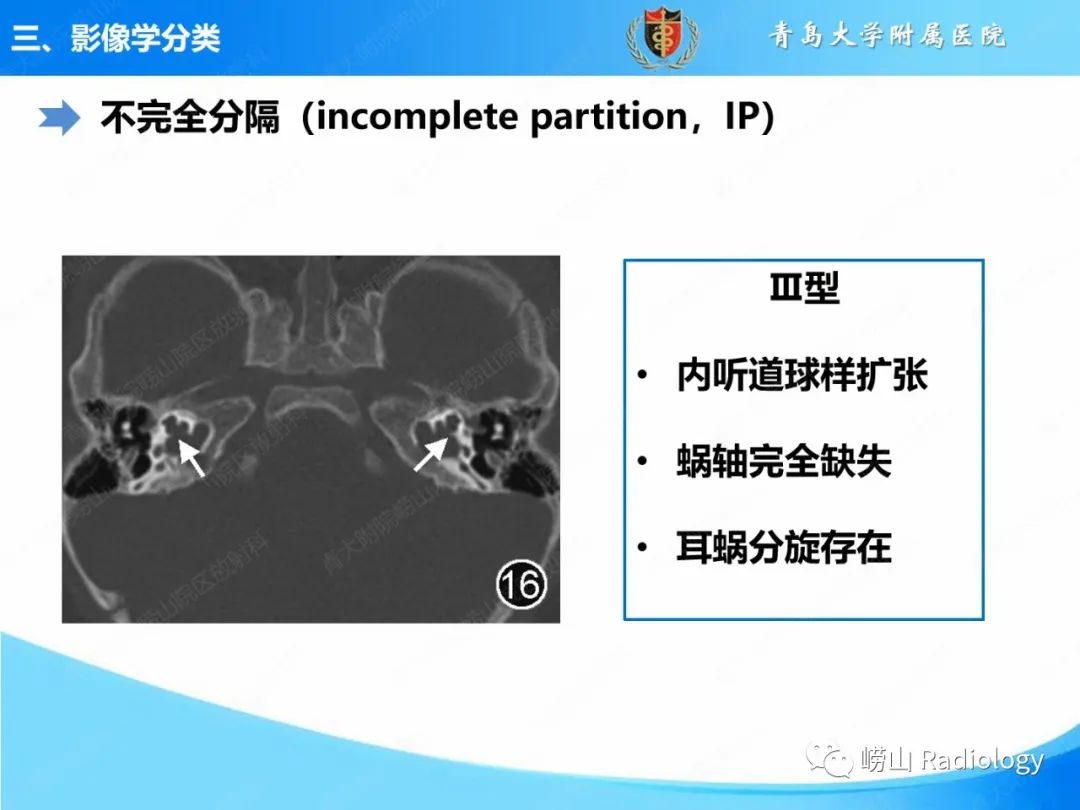 影像PPT - 【PPT】内耳畸形的影像学诊断-38