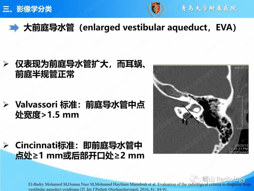 影像PPT - 【PPT】内耳畸形的影像学诊断-39