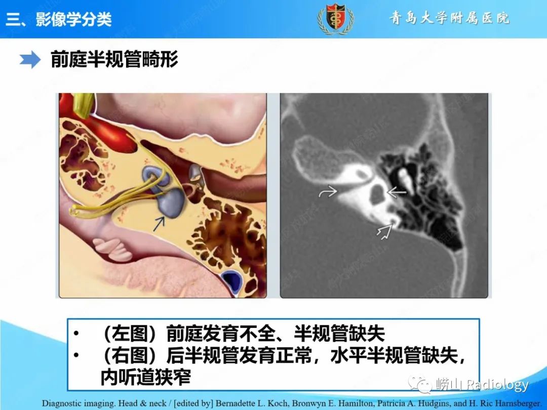 影像PPT - 【PPT】内耳畸形的影像学诊断-40