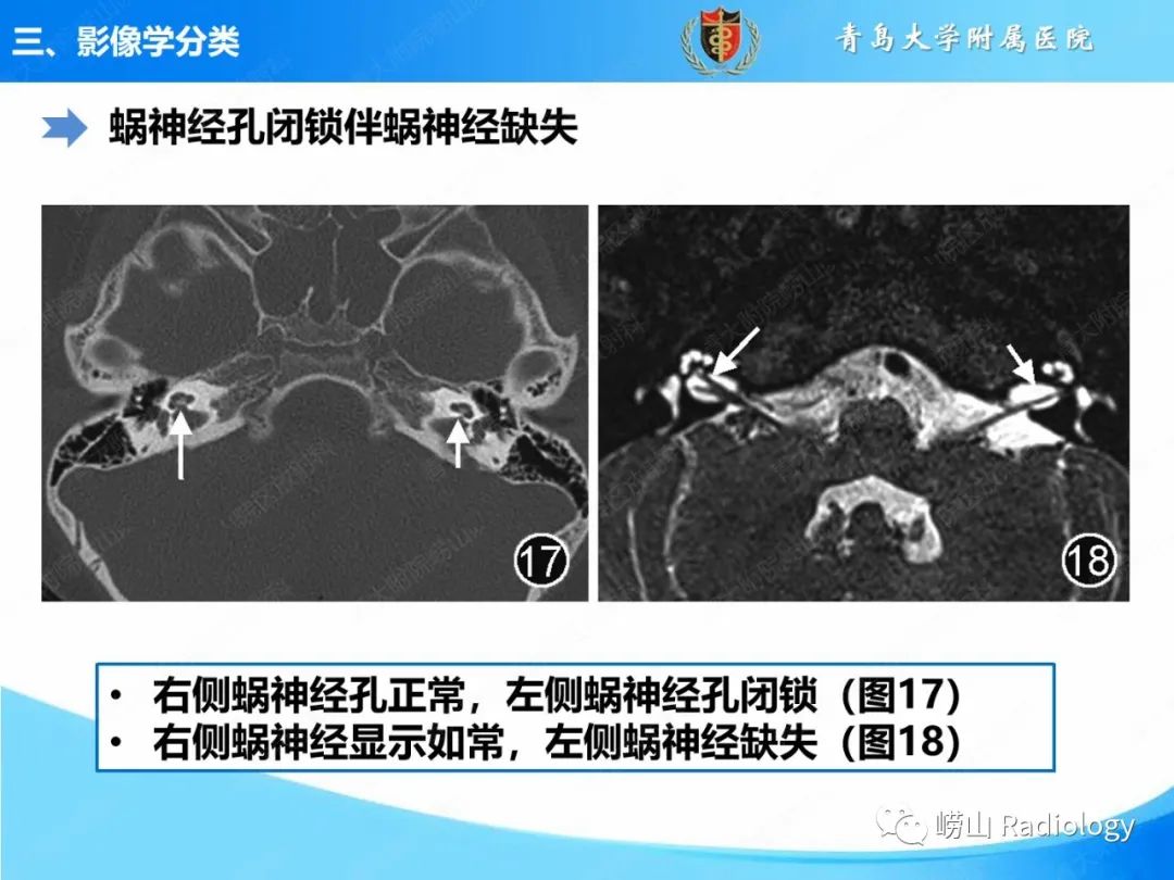 影像PPT - 【PPT】内耳畸形的影像学诊断-43