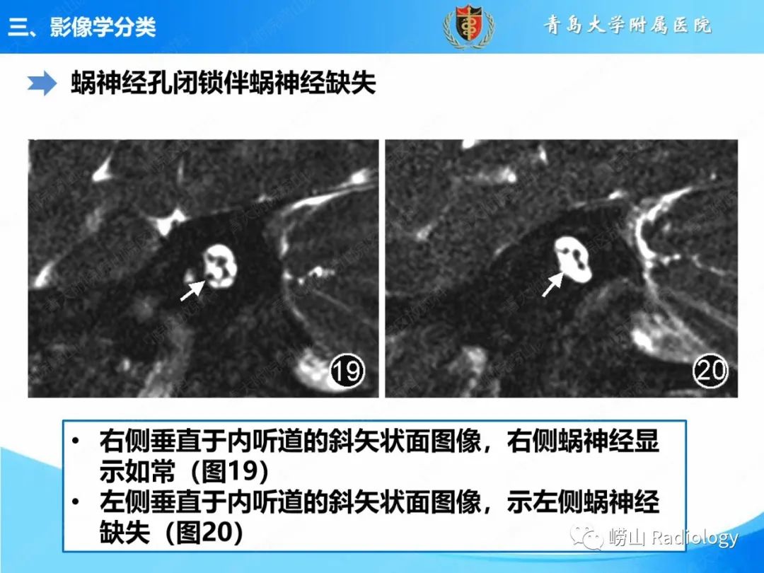 影像PPT - 【PPT】内耳畸形的影像学诊断-44