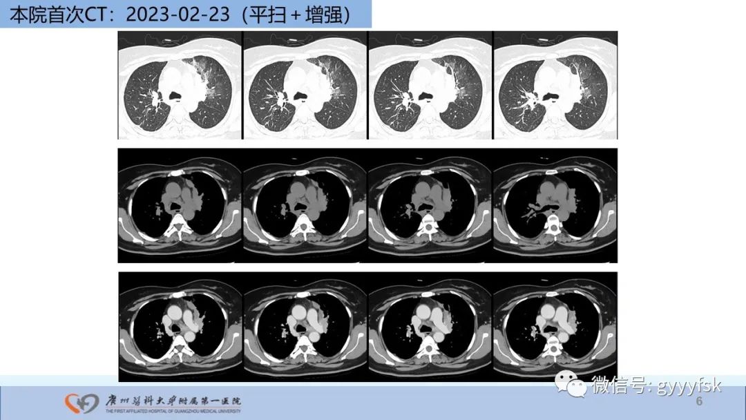 影像PPT - 【PPT】马尔尼菲篮状菌病-6