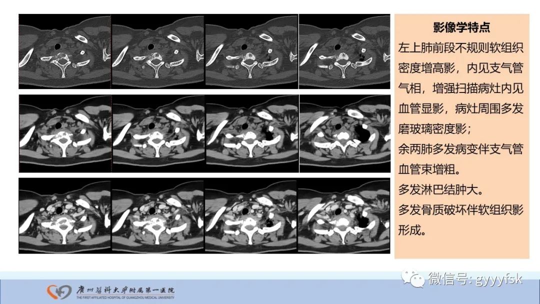 影像PPT - 【PPT】马尔尼菲篮状菌病-7