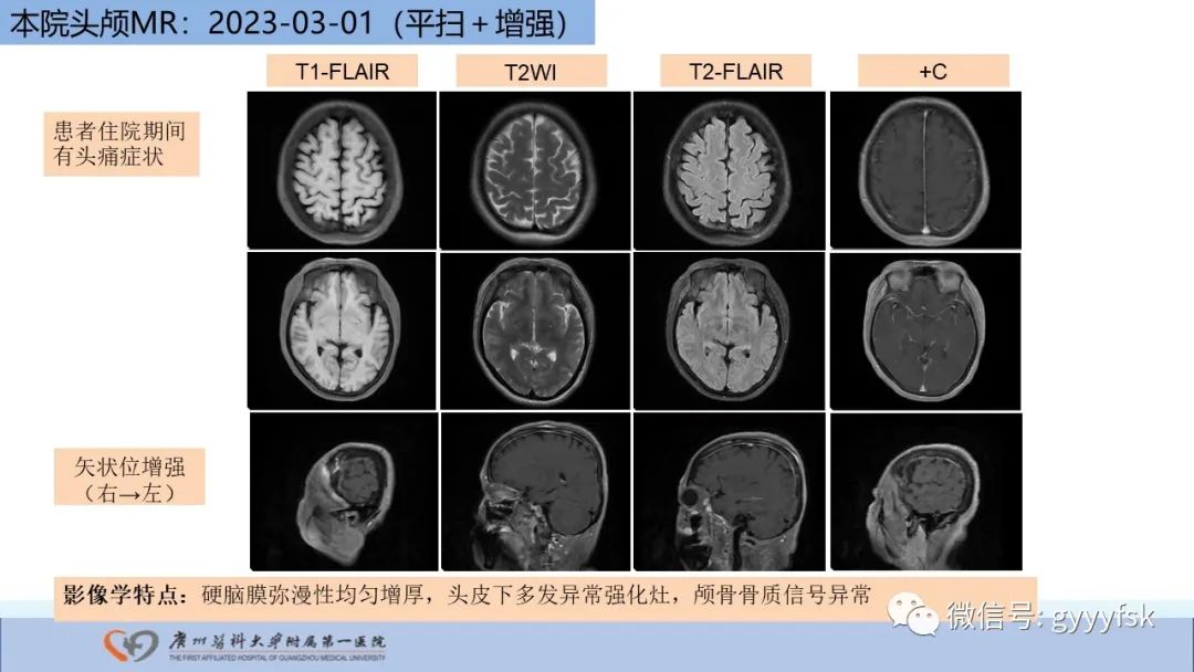影像PPT - 【PPT】马尔尼菲篮状菌病-8