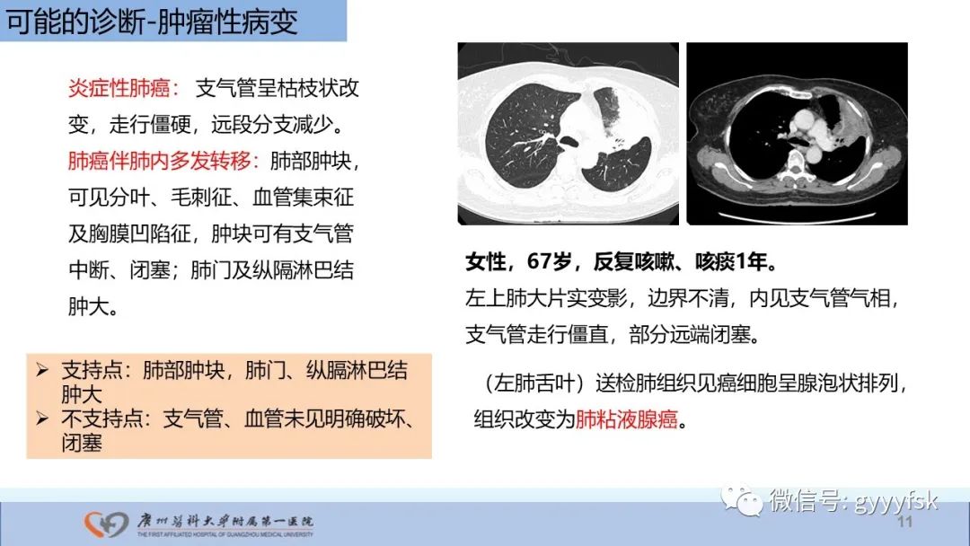 影像PPT - 【PPT】马尔尼菲篮状菌病-11