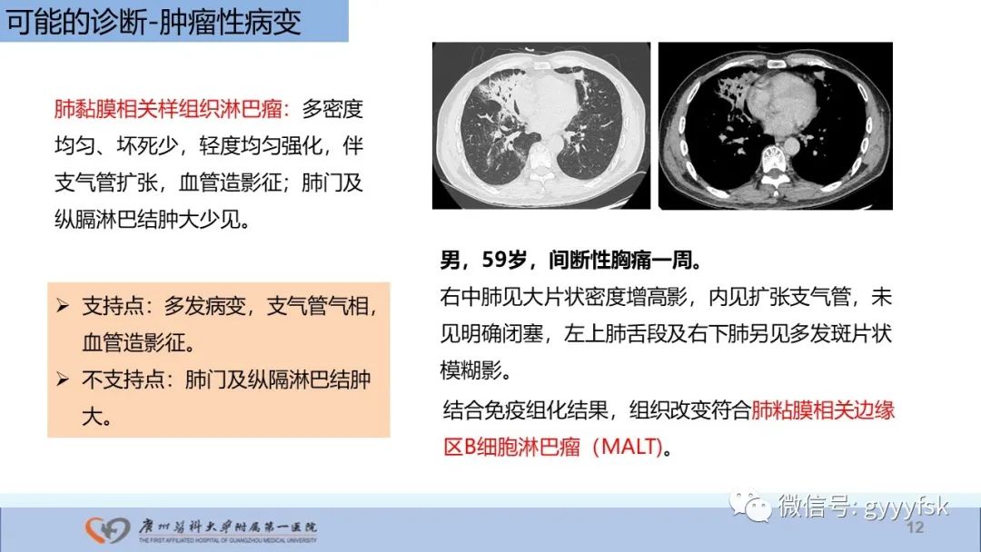影像PPT - 【PPT】马尔尼菲篮状菌病-12