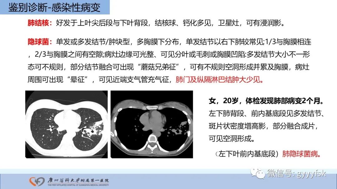 影像PPT - 【PPT】马尔尼菲篮状菌病-13