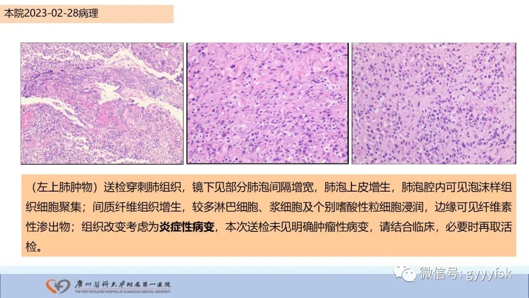 影像PPT - 【PPT】马尔尼菲篮状菌病-19