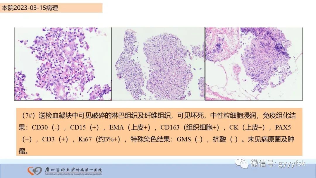 影像PPT - 【PPT】马尔尼菲篮状菌病-20