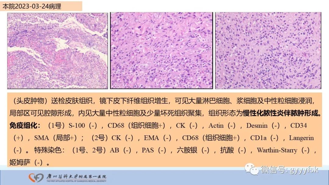 影像PPT - 【PPT】马尔尼菲篮状菌病-21