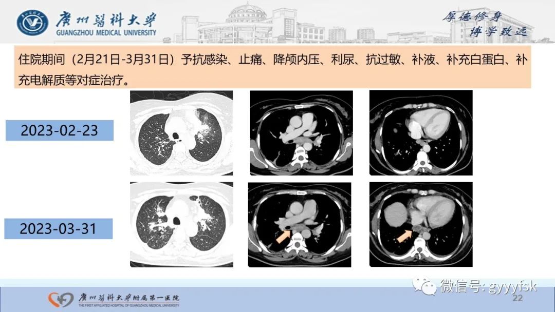 影像PPT - 【PPT】马尔尼菲篮状菌病-22
