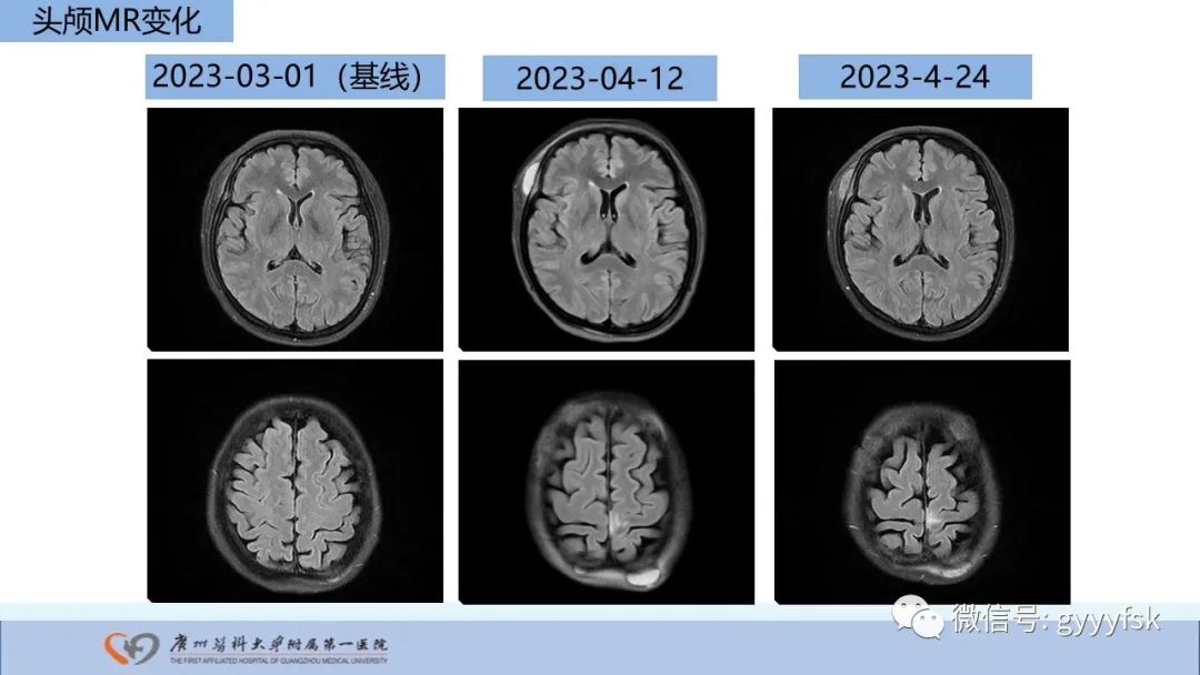影像PPT - 【PPT】马尔尼菲篮状菌病-25