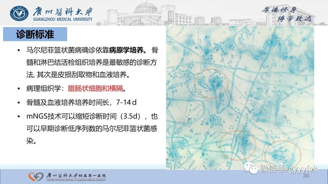 影像PPT - 【PPT】马尔尼菲篮状菌病-30