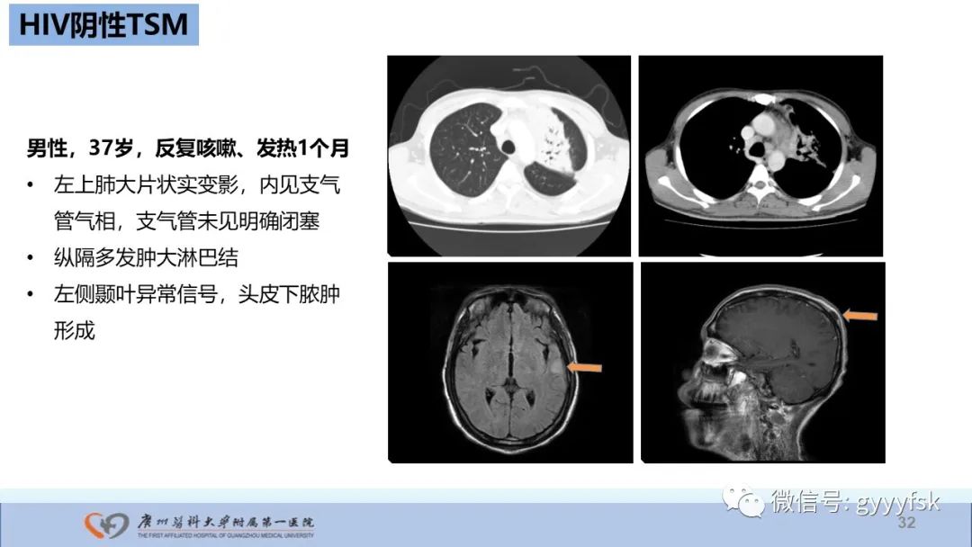 影像PPT - 【PPT】马尔尼菲篮状菌病-32