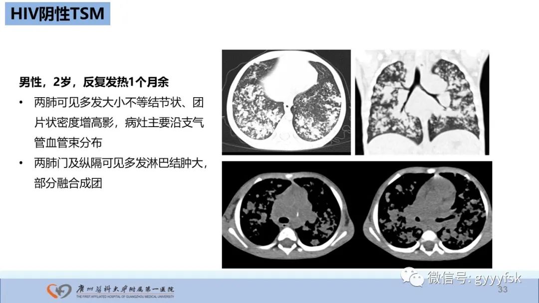影像PPT - 【PPT】马尔尼菲篮状菌病-33