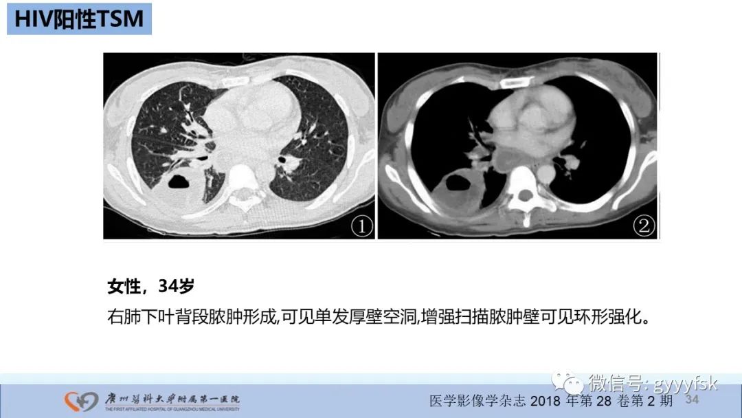 影像PPT - 【PPT】马尔尼菲篮状菌病-34
