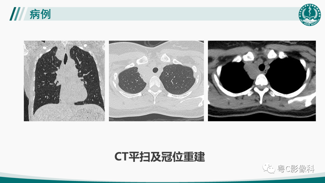 影像PPT - 【PPT】肺良性血管周上皮样细胞肿瘤影像诊断-3