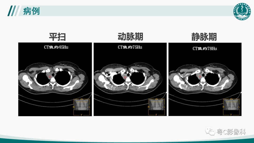 影像PPT - 【PPT】肺良性血管周上皮样细胞肿瘤影像诊断-4