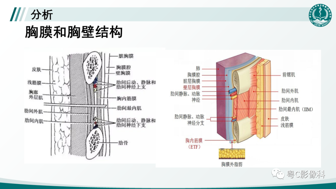 影像PPT - 【PPT】肺良性血管周上皮样细胞肿瘤影像诊断-11