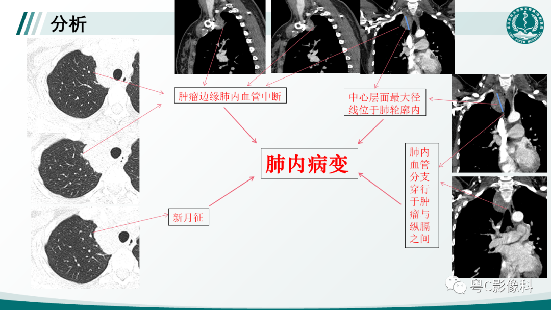 影像PPT - 【PPT】肺良性血管周上皮样细胞肿瘤影像诊断-13