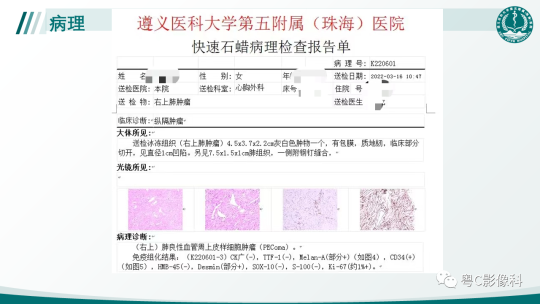 影像PPT - 【PPT】肺良性血管周上皮样细胞肿瘤影像诊断-15