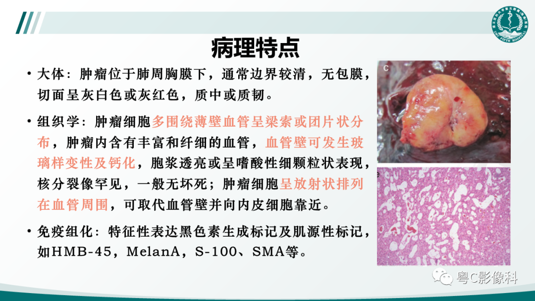 影像PPT - 【PPT】肺良性血管周上皮样细胞肿瘤影像诊断-18