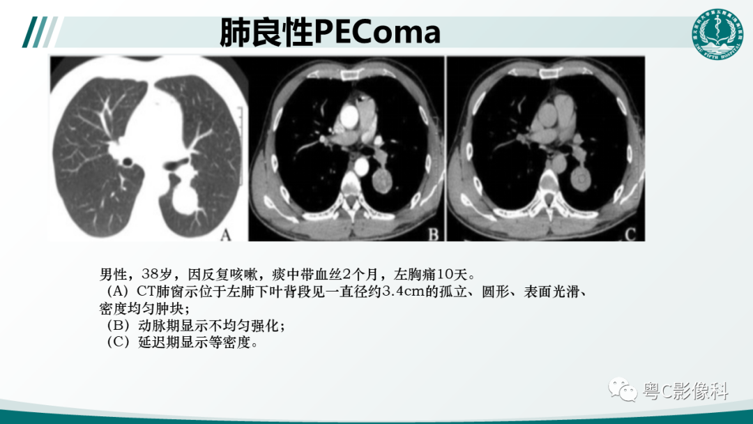影像PPT - 【PPT】肺良性血管周上皮样细胞肿瘤影像诊断-21