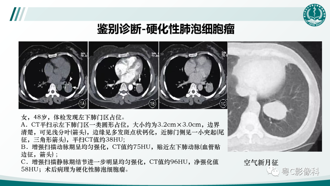 影像PPT - 【PPT】肺良性血管周上皮样细胞肿瘤影像诊断-24