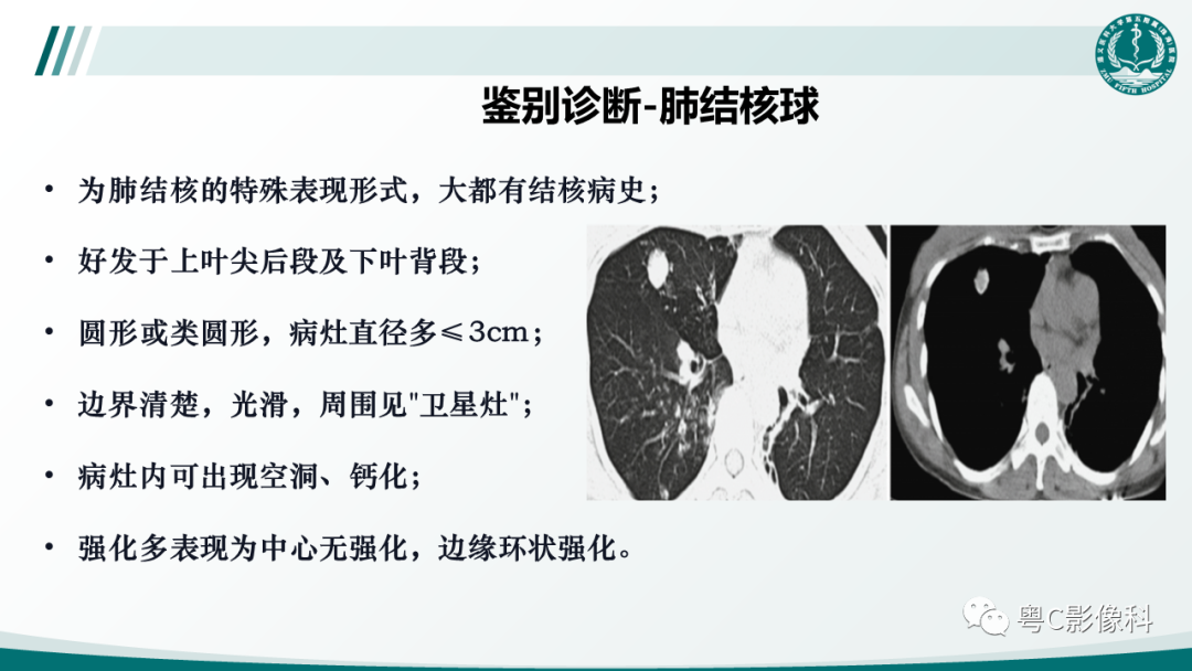 影像PPT - 【PPT】肺良性血管周上皮样细胞肿瘤影像诊断-25