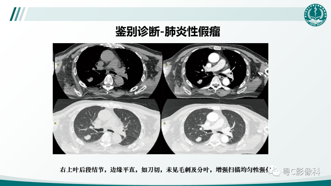 影像PPT - 【PPT】肺良性血管周上皮样细胞肿瘤影像诊断-27